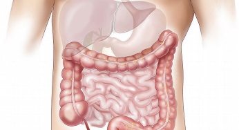 Can a Single Bout of Food Poisoning Result in Chronic Illness by Altering the Gut Microbiome?